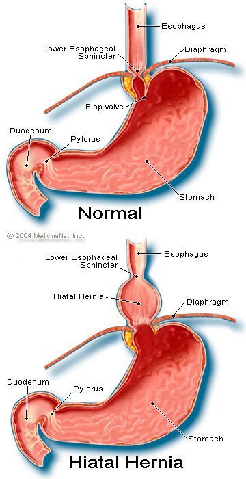 Ảnh 2 của Diaphragmatic hernia